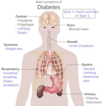 Dibujo esquemático del cuerpo humano sobre el que se nombran los síntomas de la diabetes mellitus.